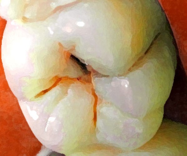 What Can I Do For A Cavity At Home What Can I Do For A Cavity At Home