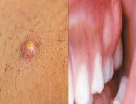 how to get rid of an abscess on the skin and teeth